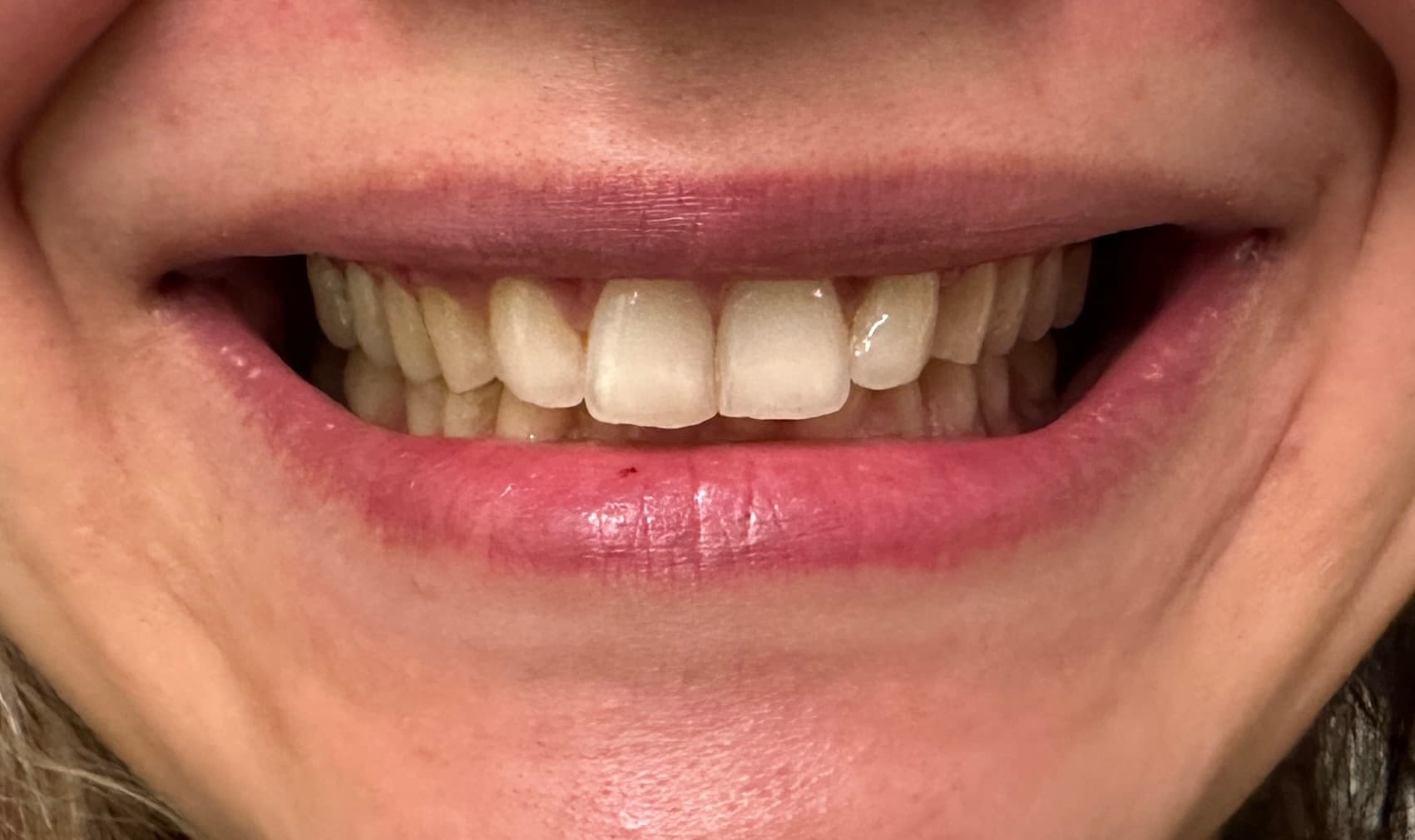 Front smile photo example