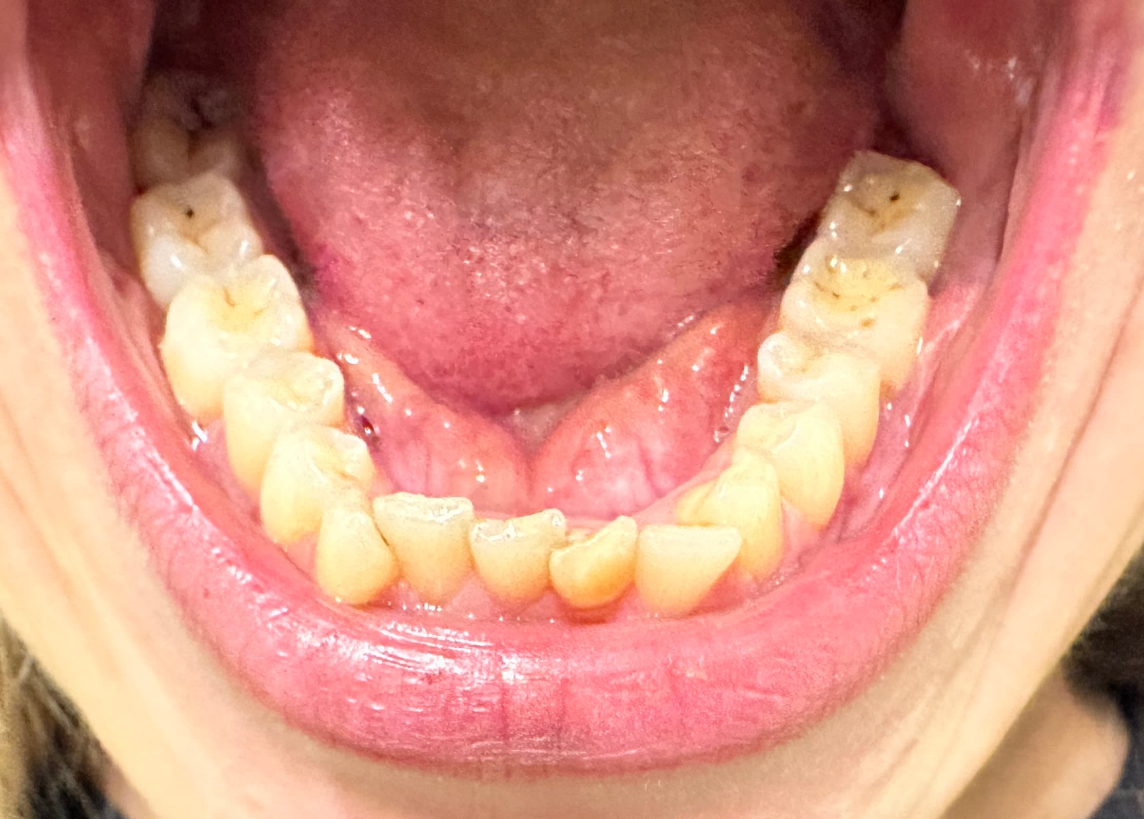 Lower teeth photo example